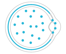 Les uvéites (ou inflammations intraoculaires) correspondent à une inflammation de l’uvée, correspondant schématiquement aux tissus internes de l’œil. L’uvée se compose de l’iris et des corps ciliaires, de la choroïde et par extension dans les uvéites de la base du vitré et de la rétine.